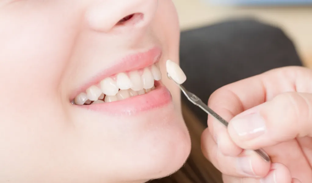 銀歯を白い歯に替えられる