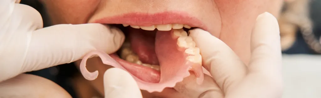 入れ歯治療とは