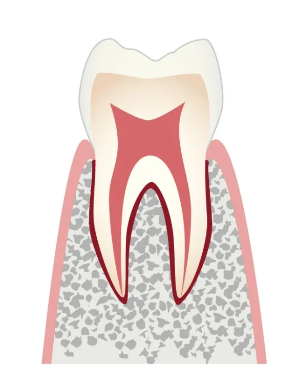 CO 初期のむし歯／主な治療法