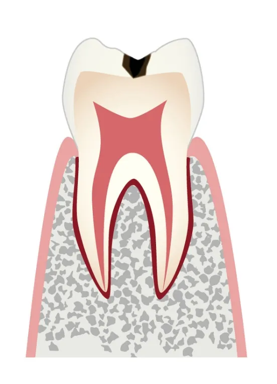 C1 エナメル質のむし歯／主な治療法