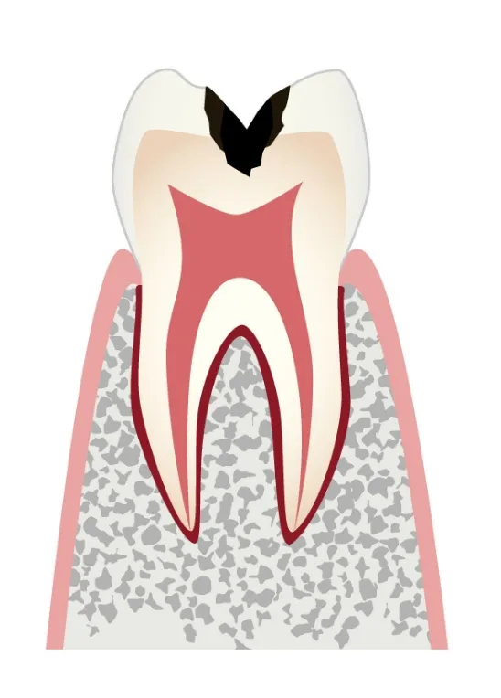 C2 象牙質のむし歯／主な治療法