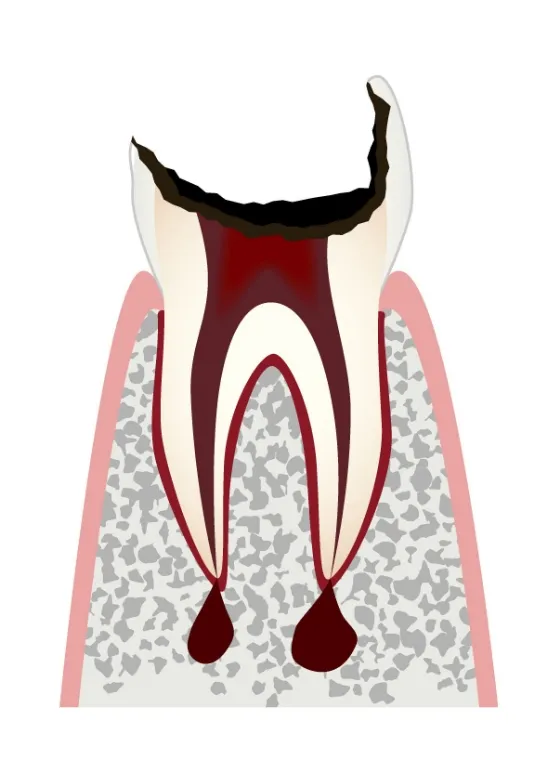 C4 歯根だけになったむし歯／主な治療法