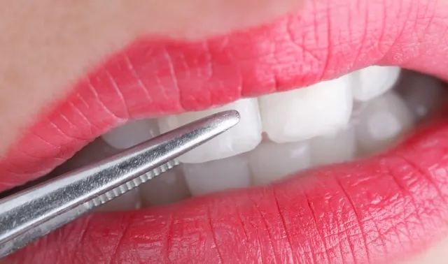 歯周病の検査方法