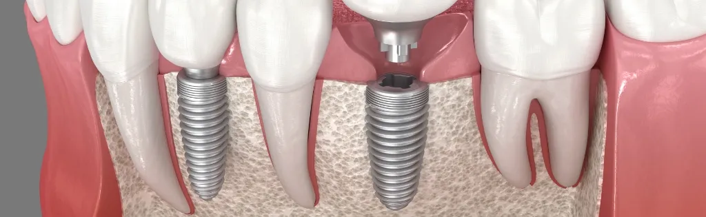 当院のインプラント治療