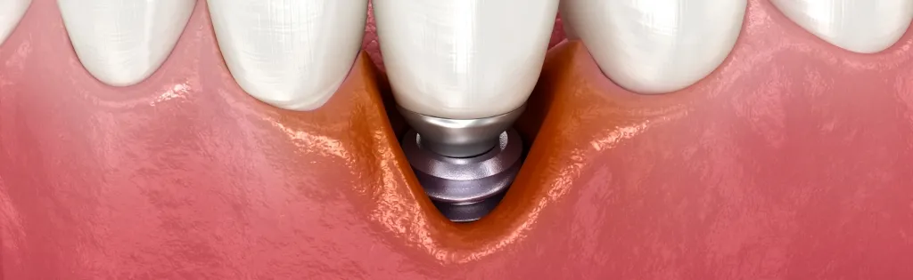 インプラントのメインテナンス