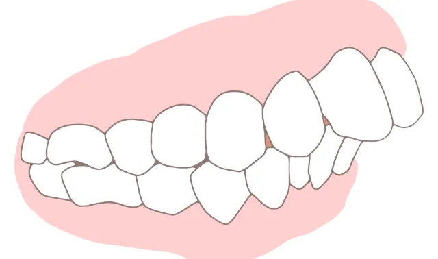 上顎前突（出っ歯）