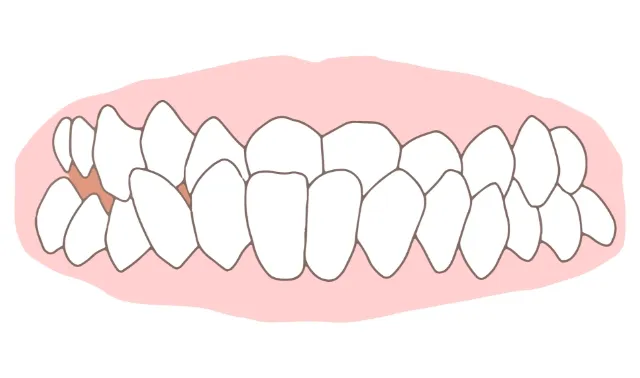下顎前突（受け口・反対咬合）