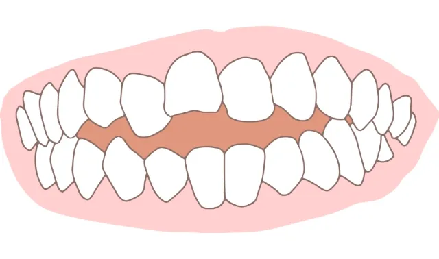 開咬（オープンバイト）