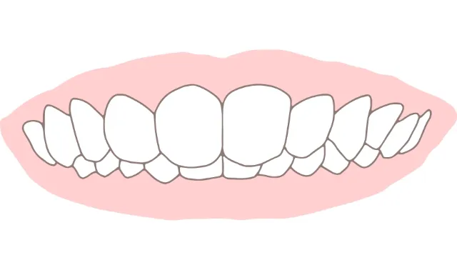 過蓋咬合（ディープバイト）