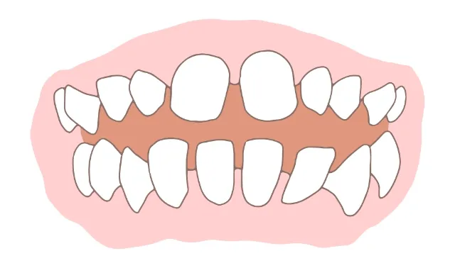空隙歯列（すきっ歯）