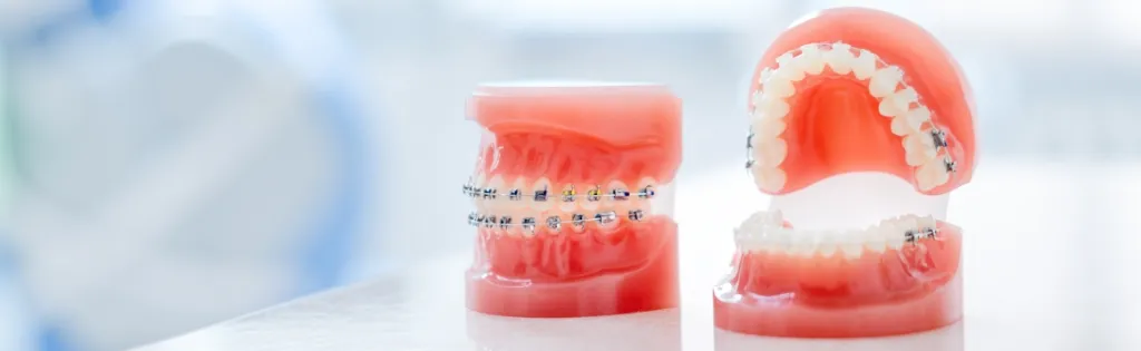 ワイヤー・ブラケットによる表側矯正