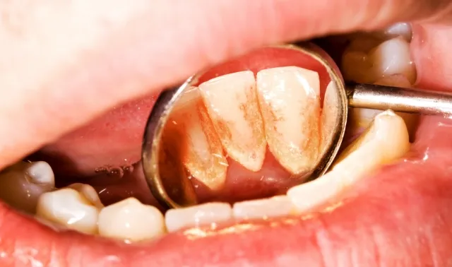 歯垢の染め出し