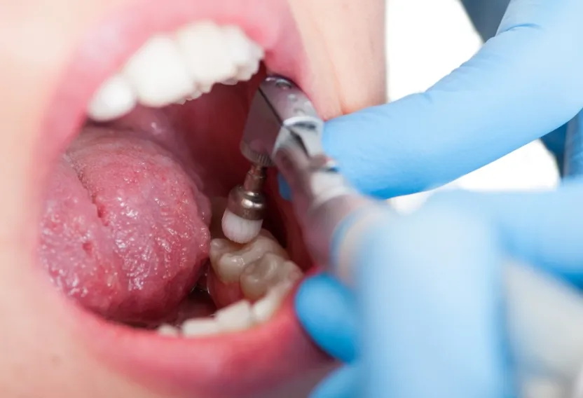 むし歯や歯周病を予防するためのケア